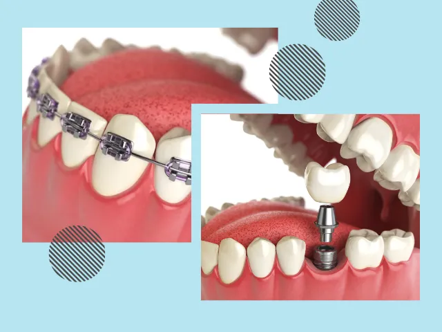 اول ایمپلنت یا ارتودنسی