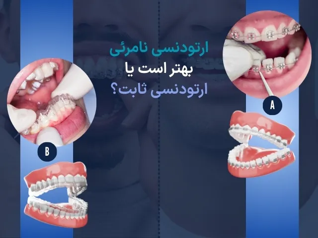 ارتودنسی نامرئی بهتر است یا ارتودنسی ثابت؟