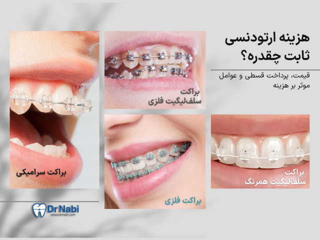 قیمت ارتودنسی ثابت در تهران + شرایط اقساط