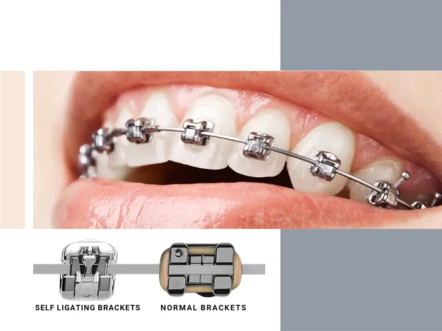 براکت های سلف لیگیتینگ در ارتودنسی