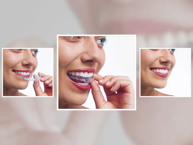 ارتودنسی نامرئی دقیقا چقدر طول میکشه؟ (6 تا 18 ماه) + 3 راه سریعتر کردن درمان