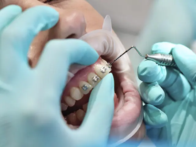 براکت ارتودنسی چیست؟ انواع براکت دندان، مزایا، نحوه نصب و مراقبت