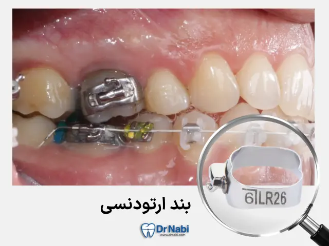 بند ارتودنسی چیست و چرا روی دندون گذاشته میشه؟