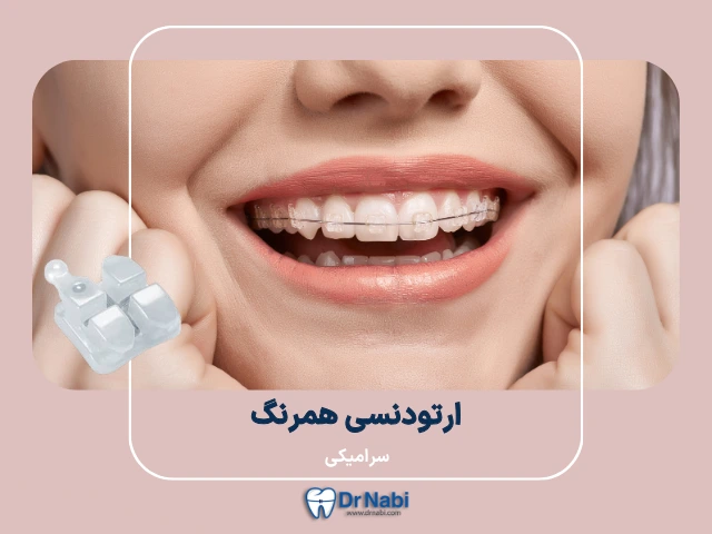ارتودنسی سرامیکی یا ارتودنسی همرنگ دندان چیست؟ مزایا، معایب و قیمت 1405