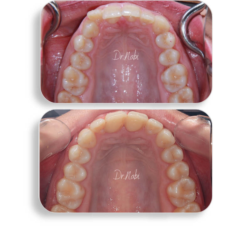 نما داخل دهان قبل درمان بیمار دیپ بایت و نما داخل دهان بعد درمان با ارتودنسی ثابت توسط دکتر نبی در یک تصویر