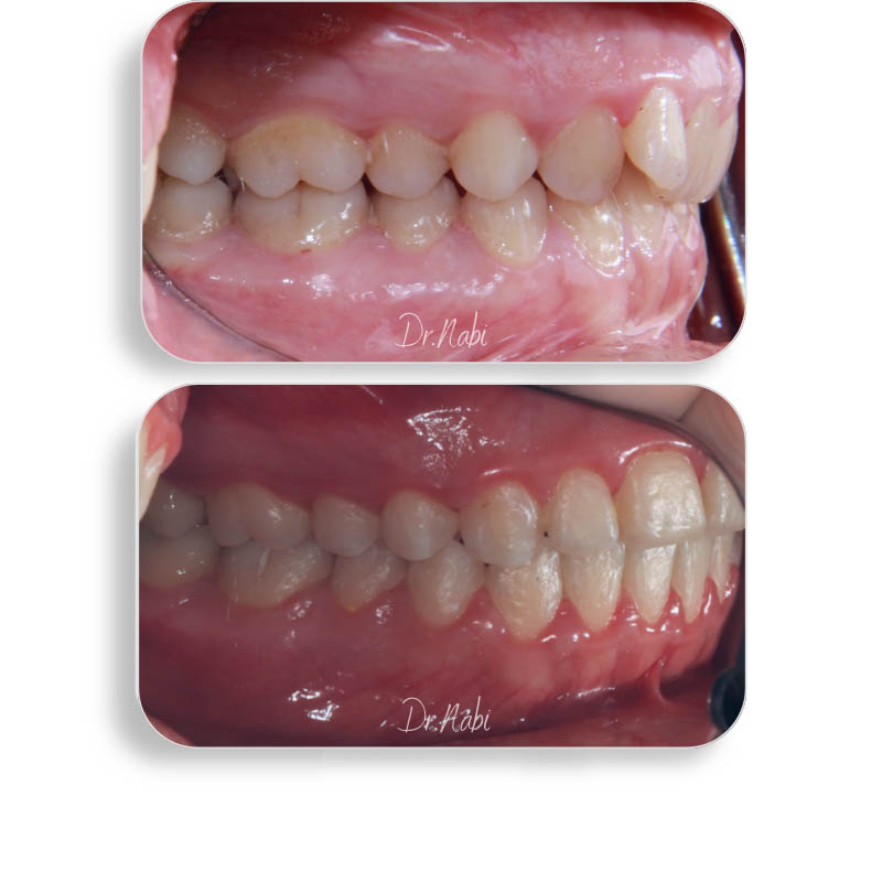 نما داخل دهان قبل درمان بیمار دیپ بایت و نما داخل دهان بعد درمان با ارتودنسی ثابت توسط دکتر نبی در یک تصویر