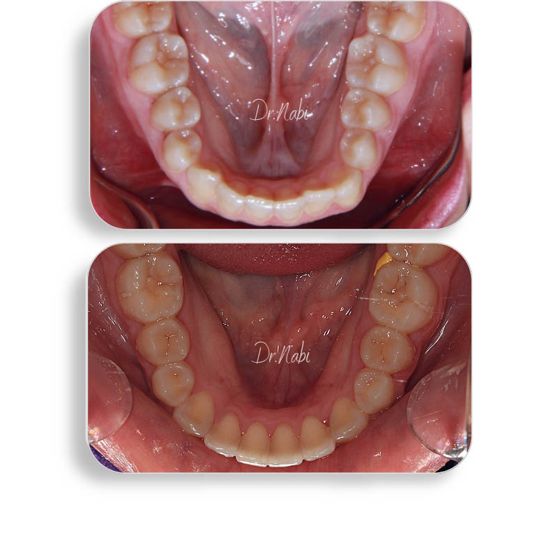 نما داخل دهان قبل درمان بیمار دیپ بایت و نما داخل دهان بعد درمان با ارتودنسی ثابت توسط دکتر نبی در یک تصویر