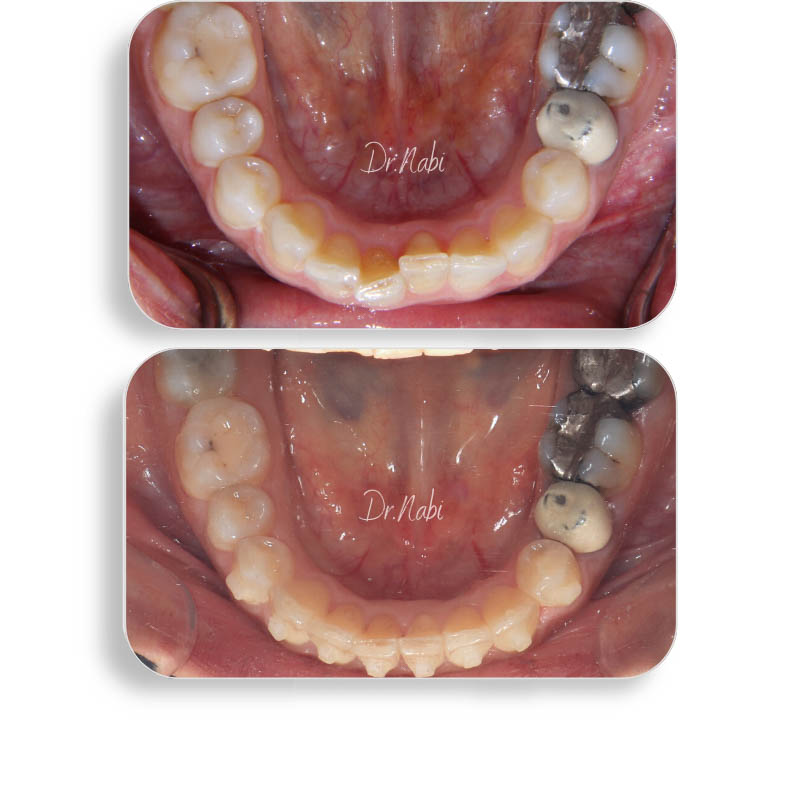 نما داخل دهان بیماربا نامرتبی دندانها فک پایین قبل درمان و نما داخل دهان فک پایین بعد درمان با ارتودنسی نامرئی توسط دکتر نبی در یک تصویر