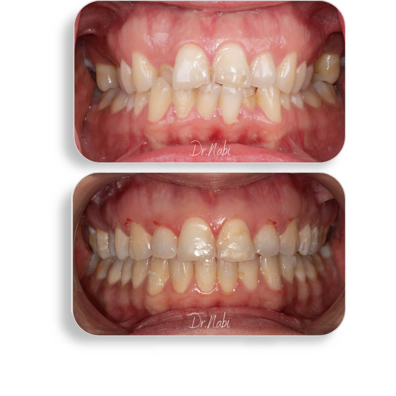 نما داخل دهان بیمار با نامرتبی شدید دندانها قبل درمان و نما داخل دهان بعد درمان با ارتودنسی نامرئی توسط دکتر نبی در یک تصویر