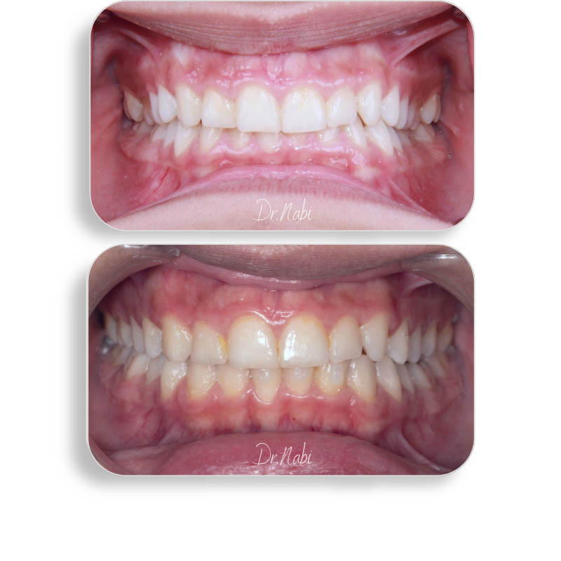 نما داخل دهان بیمار با دیپ بایت و نامرتبی دندانها قبل درمان و نما داخل دهان بعد درمان با ارتودنسی شفاف توسط دکتر نبی در یک تصویر