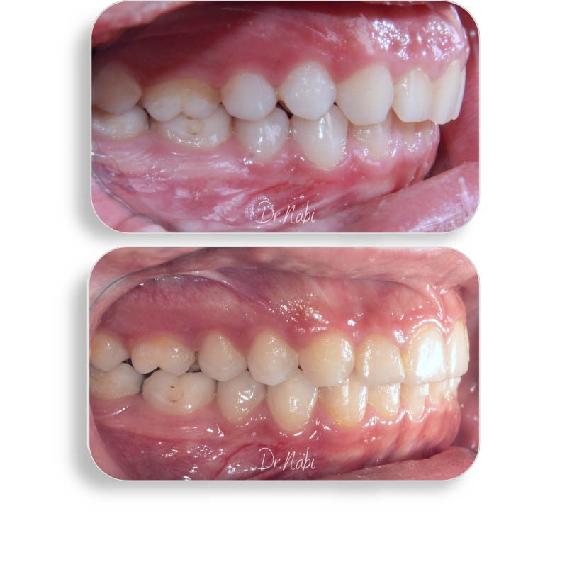 نما داخل دهان بیمار با دیپ بایت و نامرتبی دندانها قبل درمان و نما داخل دهان بعد درمان با ارتودنسی شفاف توسط دکتر نبی در یک تصویر