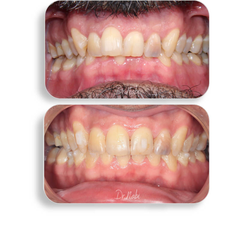 نما داخل دهان بیمار با نامرتبی دندانها و دیپ بایت متوسط  قبل درمان و نما داخل دهان بعد درمان با ارتودنسی نامرئی توسط دکتر نبی در یک تصویر