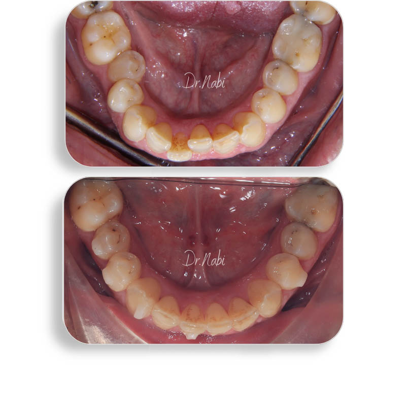 نما داخل دهان بیمار با نامرتبی دندانها و دیپ بایت متوسط  قبل درمان و نما داخل دهان بعد درمان با ارتودنسی نامرئی توسط دکتر نبی در یک تصویر