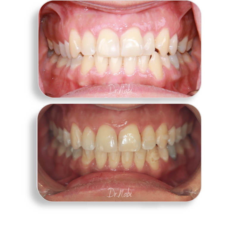 نما داخل دهان بیمار با نامرتبی دندانها وکراس بایت قبل درمان و نما داخل دهان بعد درمان با ارتودنسی نامرئی توسط دکتر نبی در یک تصویر