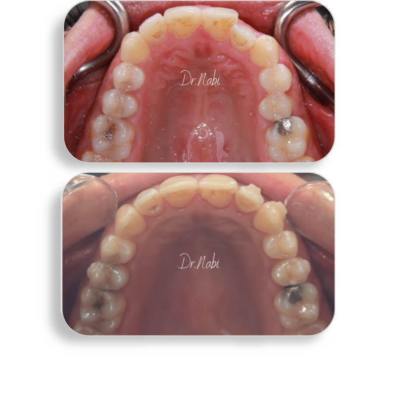 نما داخل دهان بیمار با نامرتبی دندانها وکراس بایت قبل درمان و نما داخل دهان بعد درمان با ارتودنسی نامرئی توسط دکتر نبی در یک تصویر