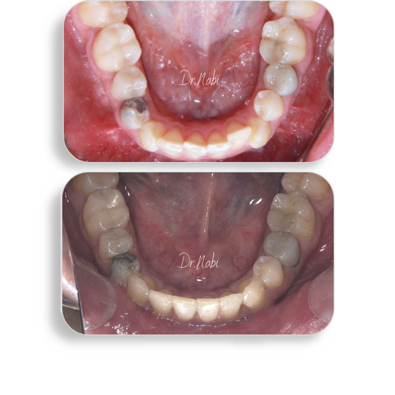 نما داخل دهان بیمار با نامرتبی دندانها وکراس بایت قبل درمان و نما داخل دهان بعد درمان با ارتودنسی نامرئی توسط دکتر نبی در یک تصویر