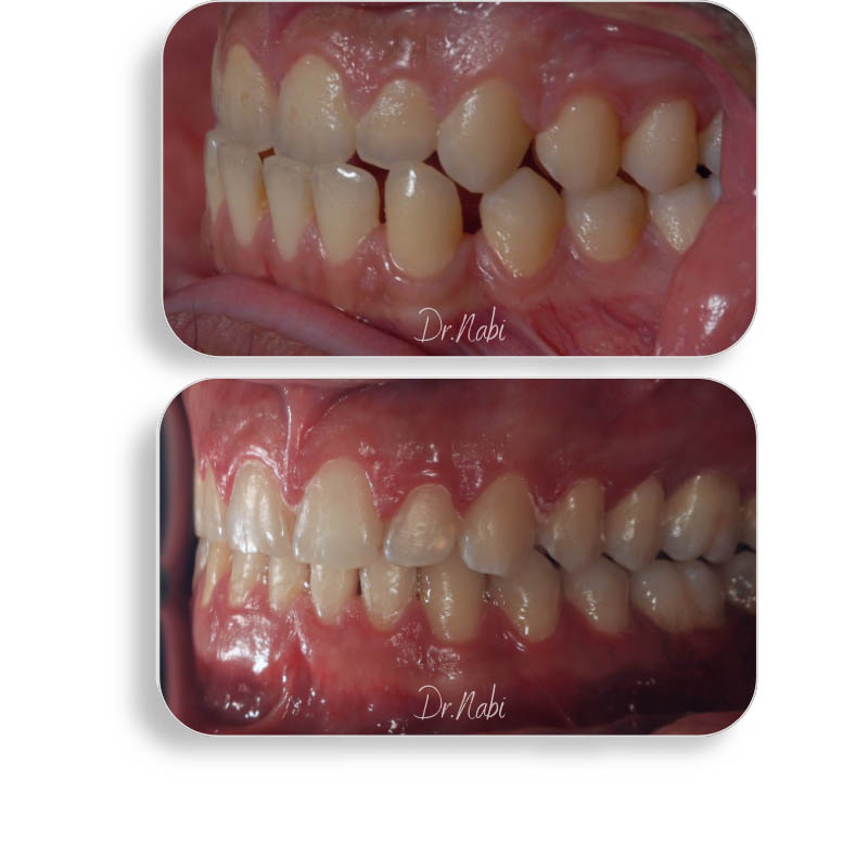 نما داخل دهان بیرون زدگی فک پایین و فواصل بین دندانی قبل درمان و نما داخل دهان بعد درمان با ارتودنسی نامرئی توسط دکتر نبی در یک تصویر