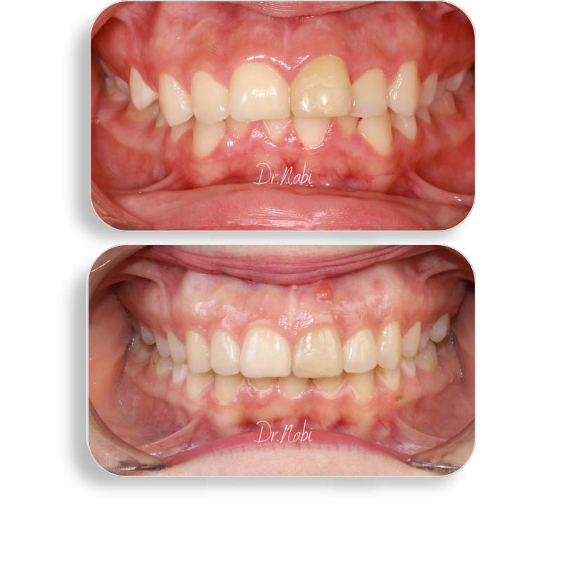 نما داخل دهان با نامرتبی دندانها و مشکل سیزوربایت قبل درمان و نما داخل دهان بعد درمان با ارتودنسی نامرئی توسط دکتر نبی در یک تصویر