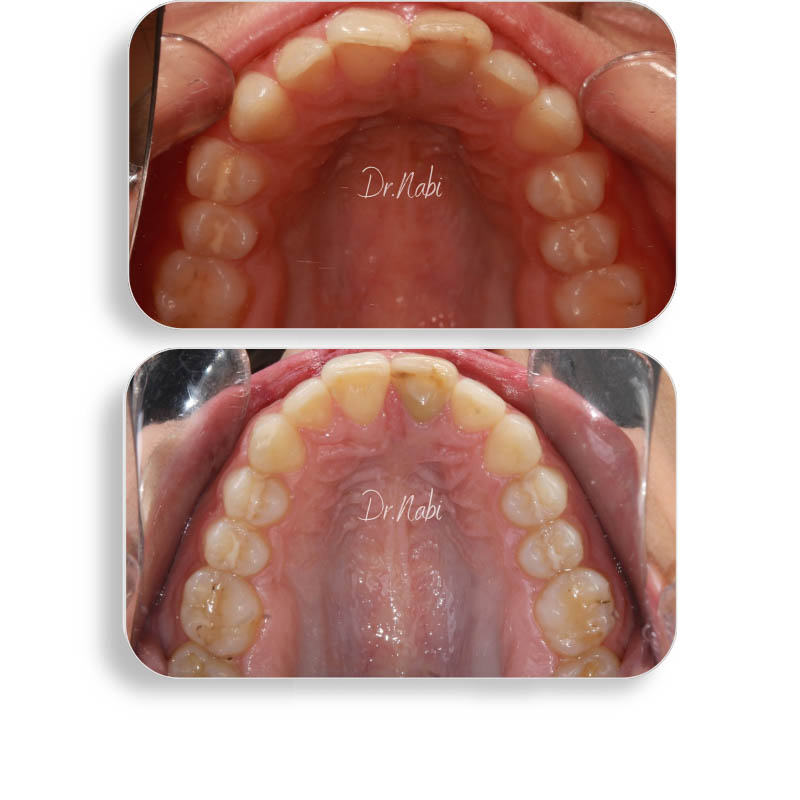 نما داخل دهان با نامرتبی دندانها و مشکل سیزوربایت قبل درمان و نما داخل دهان بعد درمان با ارتودنسی نامرئی توسط دکتر نبی در یک تصویر