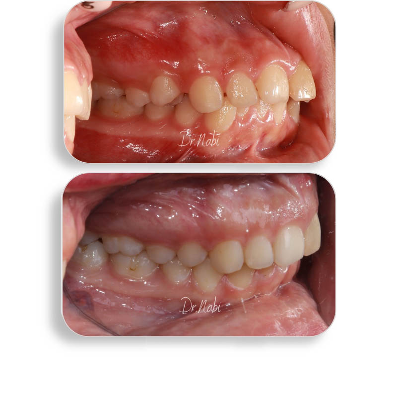 نما داخل دهان با نامرتبی دندانها و مشکل سیزوربایت قبل درمان و نما داخل دهان بعد درمان با ارتودنسی نامرئی توسط دکتر نبی در یک تصویر