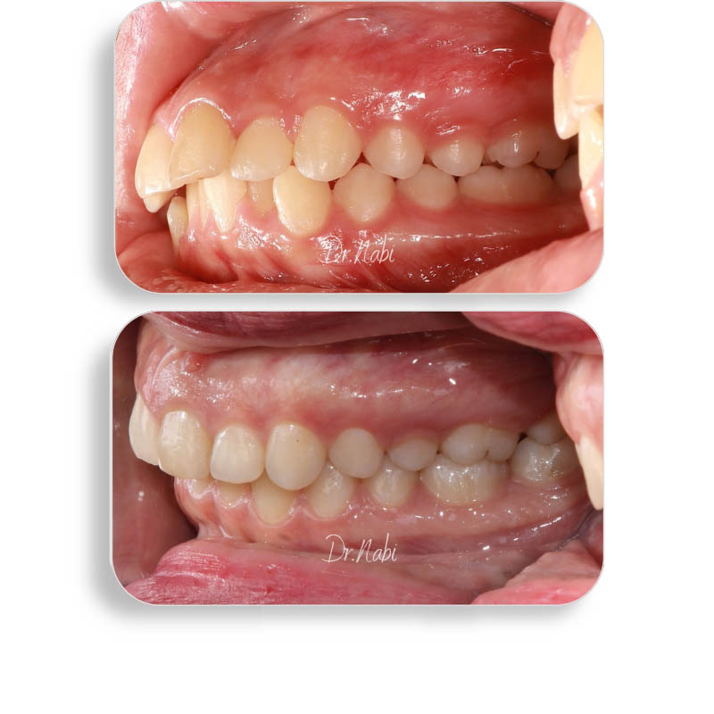 نما داخل دهان با نامرتبی دندانها و مشکل سیزوربایت قبل درمان و نما داخل دهان بعد درمان با ارتودنسی نامرئی توسط دکتر نبی در یک تصویر
