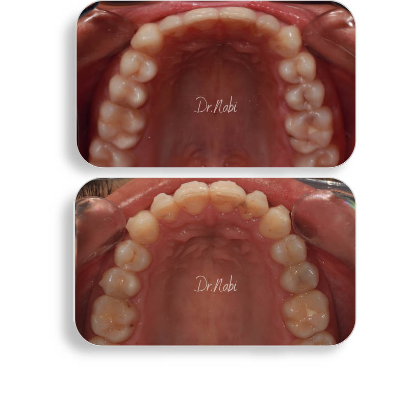 نما داخل دهان بیمار با نامرتبی دندانها واپن بایت خفیف  قبل درمان و نما داخل دهان بعد درمان با ارتودنسی نامرئی توسط دکتر نبی در یک تصویر