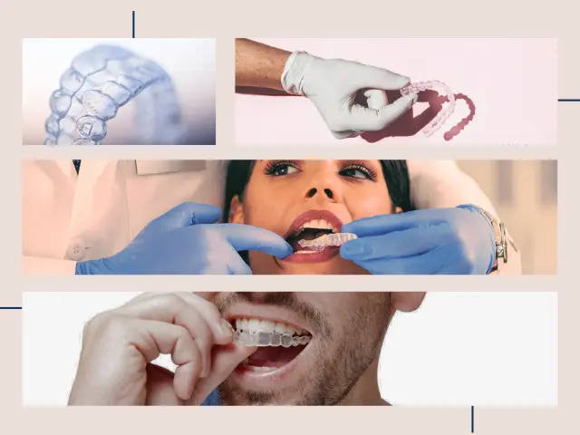 ارتودنسی نامرئی - مزایا، هزینه و الاینر شفاف با دکتر نبی
