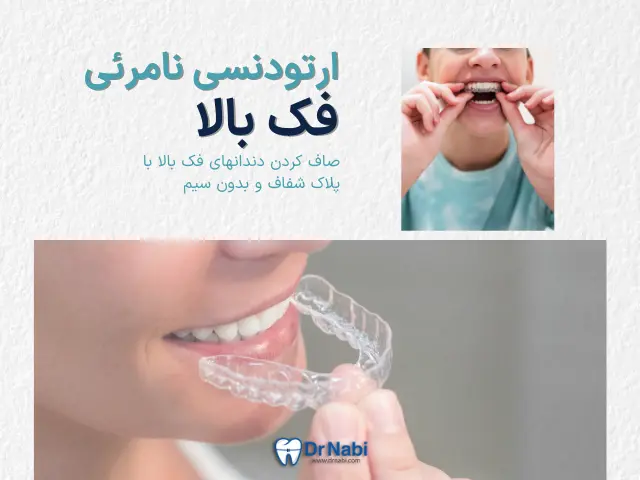 ارتودنسی نامرئی فک بالا -  طراحی اختصاصی الاینرها توسط دکتر نبی