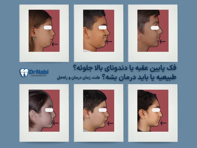 دندونای بالای بچه جلوئه یا فک پایینش عقبه؟ همه چیز درباره ناهنجاری کلاس 2 در کودکان