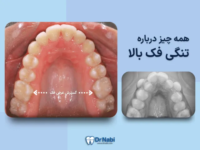 تنگی فک بالا چیست؟ علائم، علت ها و روش های درمان