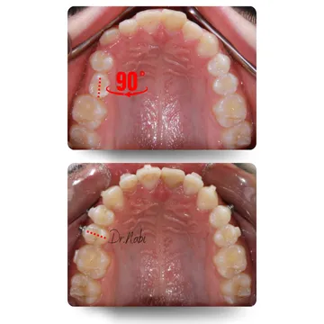 دو نمای اکلوزال قبل و بعد درمان ارتودنسی شفاف از روتیشن ۹۰ درجه دندان پرمولر و اصلاح آن