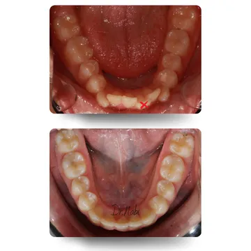 دو نمای اکلوزال قبل و بعد درمان ارتودنسی شفاف در بیمار با نامرتبی نسبتا شدید و کمبود فضا که یک دندان جلویی فک پایین کشیده شد