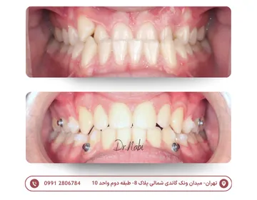دو نمای داخل دهان از خط میانی قبل و بعد درمان ارتودنسی شفاف برای اصلاح دندان‌های جلوی فک بالا که پشت فک پایین قرار داشتند