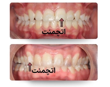 دو نمای داخل دهان از خط میانی برای نمایش اتچمنت‌های ارتودنسی شفاف