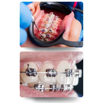 کلوزآپ داخل دهان با براکت‌های فلزی ارتودنسی ثابت روی دندان‌ها