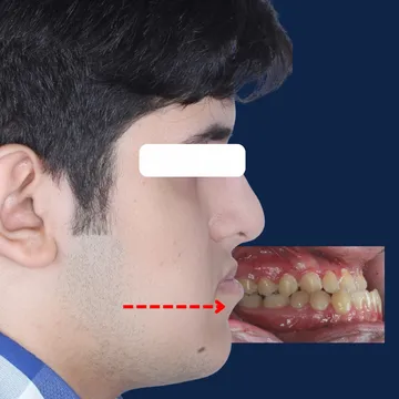 کیس جراحی، نیمرخ صورت و اکلوژن داخل دهان بیمار با کلاس 3 (Class III) و آندربایت (Underbite) قبل از درمان ارتودنسی