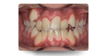 نمای داخل دهان بیمار با شلوغی شدید دندانی (Crowding) قبل از درمان ارتودنسی