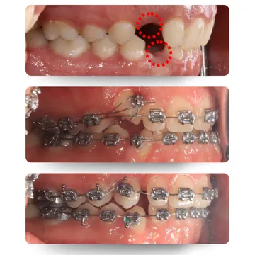 سه نمای اکلوژن از بیرون آمدن دندان نیش نهفته (Impacted Canine) قبل از درمان ارتودنسی
