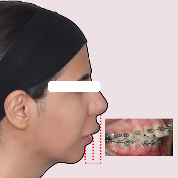 نیم‌رخ صورت و اکلوژن داخل دهان بیمار با کلاس دو (Class II) و اورجت زیاد (Overjet) قبل از درمان