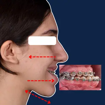 نیمرخ صورت بیمار با کلاس سه (Class III) قبل از جراحی فک در درمان ارتوسرجری با ارتودنسی دکتر نبی