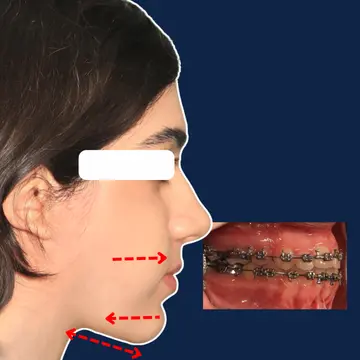 نیمرخ صورت بیمار با کلاس سه (Class III) بعد از جراحی فک در درمان ارتوسرجری با ارتودنسی دکتر نبی