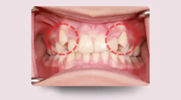 نمای داخل دهان با دندان نیش خارج از قوس و میدلاین (Canine Out of Arch, Midline) قبل از درمان