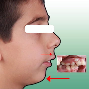 عکس نیم رخ و اکلوژن کودک با ناهنجاری کلاس 2  -  فک پایین عقب تر از فک بالا