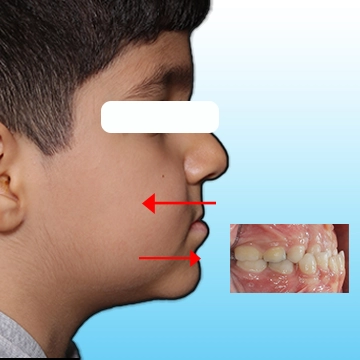 عکس نیم رخ و اکلوژن دهانی کودک با ناهنجاری کلاس 3  -  فک پایین جلوتر از فک بالا