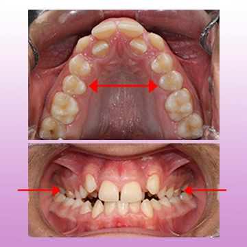 نما اکلوزال تنگی فک بالا و نما میدلاین تنگی فک بالا بیمار، قبل درمان که نیاز به دستگاه هایرکس دارد در یک تصویر