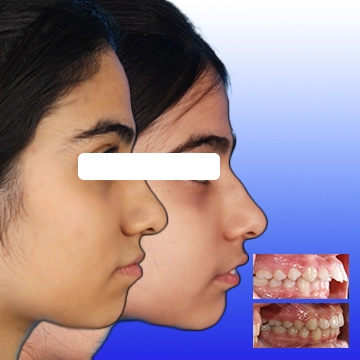 نما نمیرخ صورت کودک قبل و بعد و اکلوژن راست داخل دهانی قبل و بعد درمان - نمونه درمان کلاس 2 با دستگاه فانکشنال در یک تصویر