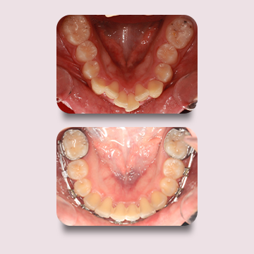 نما اکلوزال پایین قبل درمان و نما اکلوزال پایین پایان درمان با ارتودنسی ثابت فلزی توسط دکتر نبی در یک تصویر