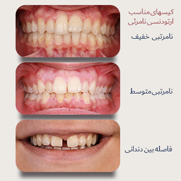 کیسهای مناسب درمان با ارتودنسی نامرئی سه نما از میدلاین داخل دهان بیماران دکتر نبی. کیسهای مناسب درمان با ارتودنسی نامرئی. نامرتبی خفیف، نامرتبی متوسط و فاصله بین دندانی قبل درمان در یک تصویر