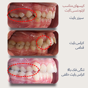 کیسهای مناسب درمان با ارتودنسی ثابت سه نما از اکلوژن راست داخل دهان بیماران دکتر نبی. کیسهای مناسب درمان با ارتودنسی ثابت. سیزربایت، کراس بایت و تنگی فک بالا قبل درمان در یک تصویر