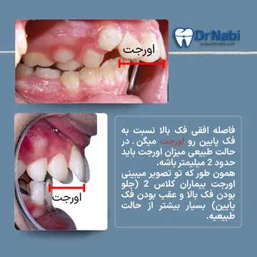 اورجت زیاد در ناهنجاری کلاس 2 کودکان نمای اوکلوژن سمت راست و نمای اوورجت زیاد در کودک با ناهنجاری فکی کلاس 2 در یک تصویر